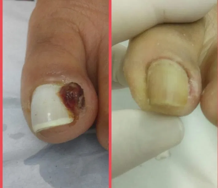 Antes e depois — unha encravada