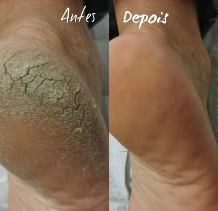 Antes e depois — fissuras