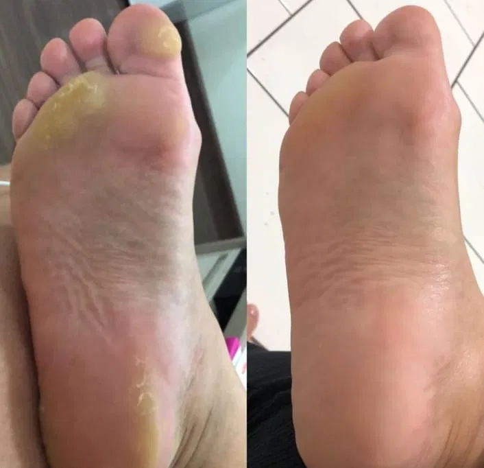Antes e depois — calos