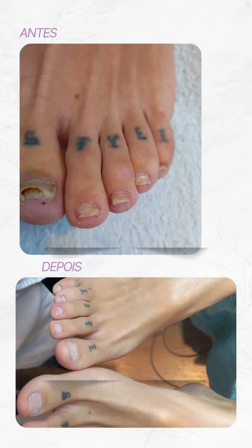 Antes e depois — micose de unha